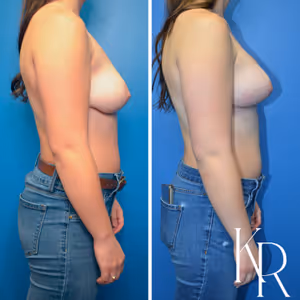 Breast lift with implants before and after photo, side view