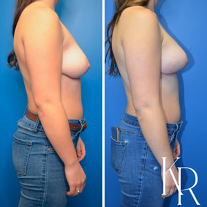 Breast lift with implants before and after photo, side view