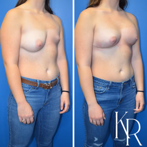 Breast lift with implants before and after photo, front view