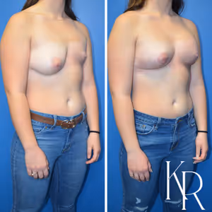 Breast lift with implants before and after photo, front view
