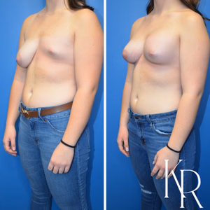 Breast lift with implants before and after photo, front view