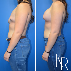 Breast lift with implants before and after photo, side view
