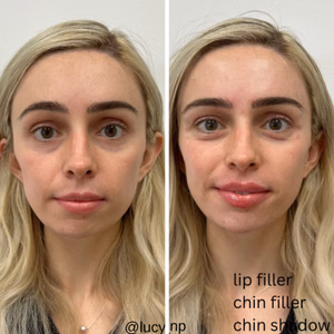 Dermal filler before and after photo, front view