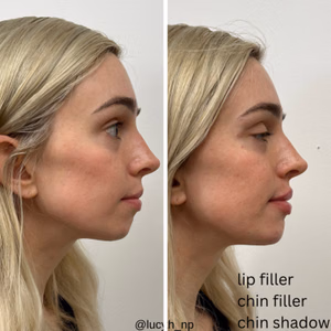 Dermal filler before and after photo, side view
