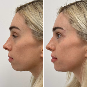 Dermal filler before and after photo, side view