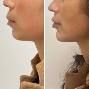 Dermal filler before and after photo, side view