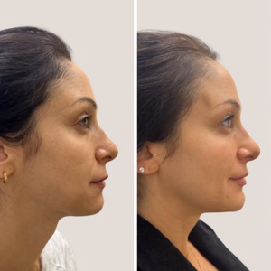 Dermal filler before and after photo, side view