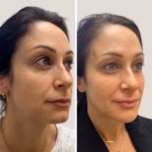 Dermal filler before and after photo, front view