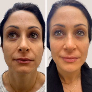Dermal filler before and after photo, front view