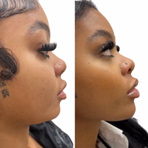 Dermal filler before and after photo, side view