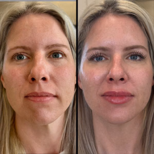 Facial balancing before and after photo, front view