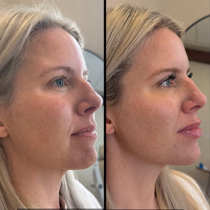Facial balancing before and after photo, side view