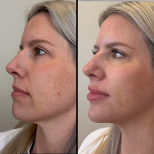Facial balancing before and after photo, side view