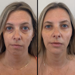 Facial balancing before and after photo, front view