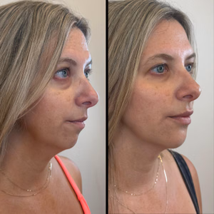 Facial balancing before and after photo, side view