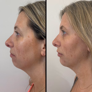 Facial balancing before and after photo, side view