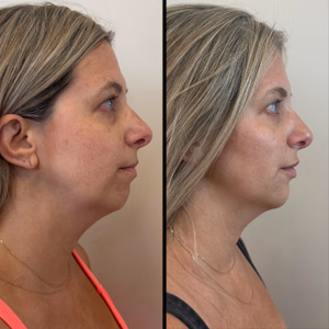Facial balancing before and after photo, side view