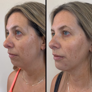 Facial balancing before and after photo, front view