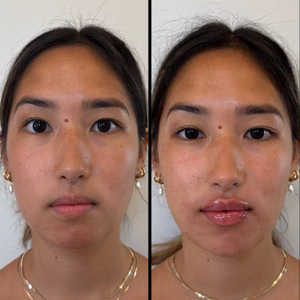 Facial balancing before and after photo, front view