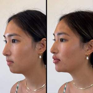 Facial balancing before and after photo, side view