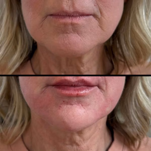 Facial balancing before and after photo, side view