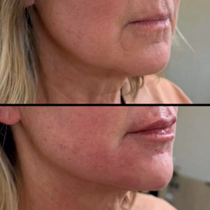 Facial balancing before and after photo, front view