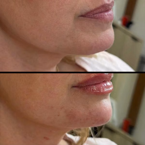 Facial balancing before and after photo, side view