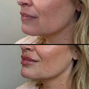 Facial balancing before and after photo, side view