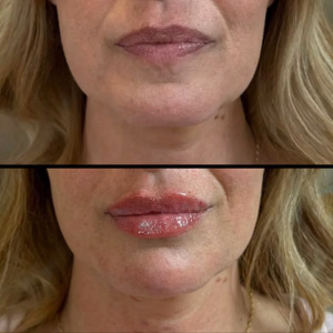 Facial balancing before and after photo, side view