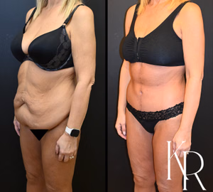 Fleur-de-lis tummy tuck before and after photo, side view