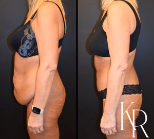 Fleur-de-lis tummy tuck before and after photo, side view