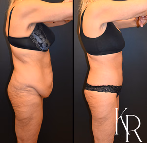 Fleur-de-lis tummy tuck before and after photo, side view