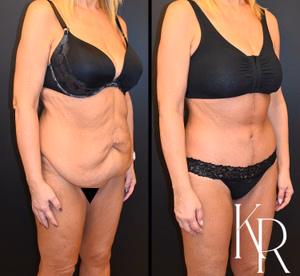 Fleur-de-lis tummy tuck before and after photo, front view