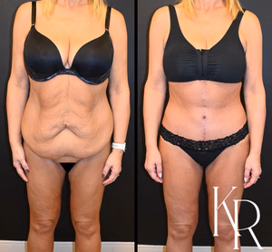 Fleur-de-lis tummy tuck before and after photo, front view