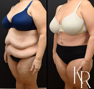 Fleur-de-lis tummy tuck before and after photo, side view