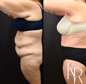 Fleur-de-lis tummy tuck before and after photo, side view