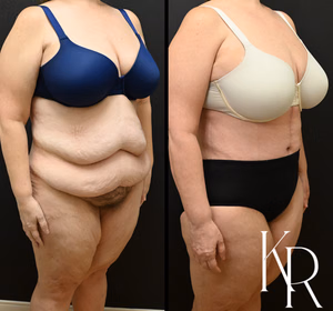 Fleur-de-lis tummy tuck before and after photo, front view