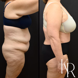 Fleur-de-lis tummy tuck before and after photo, side view