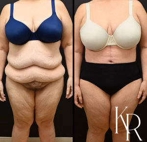 Fleur-de-lis tummy tuck before and after photo, front view