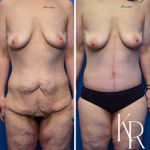 Fleur-de-lis tummy tuck before and after photo, front view
