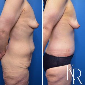 Fleur-de-lis tummy tuck before and after photo, side view