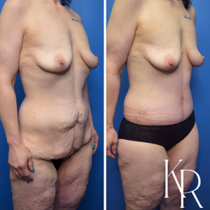 Fleur-de-lis tummy tuck before and after photo, front view