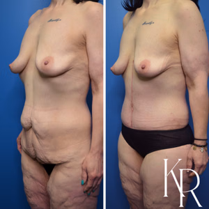 Fleur-de-lis tummy tuck before and after photo, side view