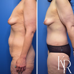 Fleur-de-lis tummy tuck before and after photo, side view