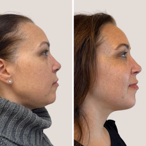Full face treatment before and after photo, side view
