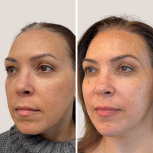 Full face treatment before and after photo, front view