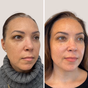 Full face treatment before and after photo, front view