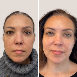 Full face treatment before and after photo, front view