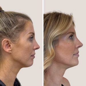 Full face treatment before and after photo, side view