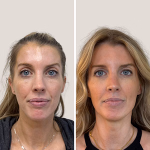 Full face treatment before and after photo, front view